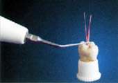 Después de limpieza de la endodoncia, usando el mecanismo y la 